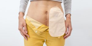 Fachgebiet: Stoma